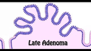 Animated Histology Colon Cancer Progression [upl. by Edyaw]