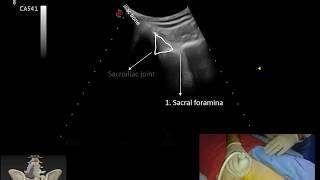 Synovial part injection in a patient with ankylosing spondylitis and ultrasonographic evaluation [upl. by Yelrebmyk]