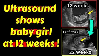 Ultrasound shows baby girl at 12 weeks pregnancy [upl. by Rosemonde]