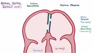 Atrial septal defect ASD repair causes types symptoms amp pathology [upl. by Chally]