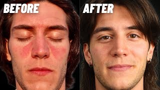 How I Cured My Seborrheic Dermatitis amp Dandruff [upl. by Niwled607]