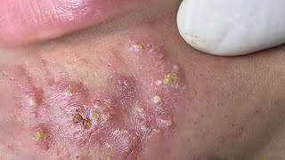 Big Cystic Acne Blackheads Extraction Blackheads amp Milia Whiteheads Removal Pimple Popping  8460 [upl. by Teiv112]