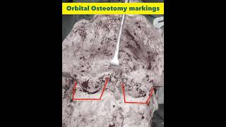 Facial Bipartition Surgery for Ocular Hypertelorism Correction at GSR Hospital Hyderabad India [upl. by Irahk397]