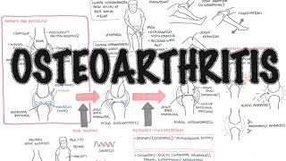 Osteoarthritis Overview causes pathophysiology investigations treatment [upl. by Annoirb187]