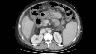 portal enteropathy [upl. by Ahl]