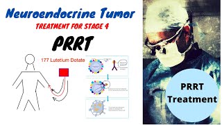 PRRT Treatment Neuroendocrine Tumors [upl. by Aklim]