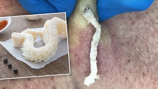 Gritty TripeLike Cyst Squeezed Out  CONTOUR DERMATOLOGY [upl. by Adnahsor480]