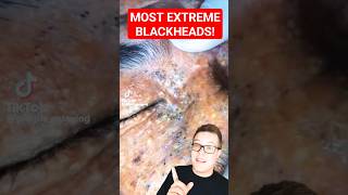 Shocking BLACKHEAD REMOVAL  Extreme Blackhead Extraction shorts [upl. by Haek37]