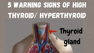 Warning signs of hyperthyroid symptoms of high thyroid thyroid ke lakshan thyroid [upl. by Maridel]