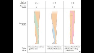 Lumbosacral radiculopathy [upl. by Nosyerg]