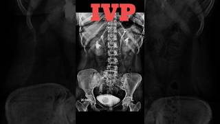 IVP  Intravenous pyelography shorts ivp specialcase radiology radiologyjunction [upl. by Blayne908]