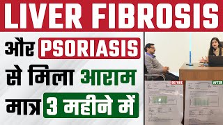 Liver Fibrosis और Psoriasis दोनों एक साथ हुए ठीक सिर्फ 3 महीने में  Reverse Fibrosis In 3 Months [upl. by Dnartreb]