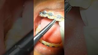 Braces wire tightening  Braces tightening  How braces works  Braces treatment in process braces [upl. by Dempstor]