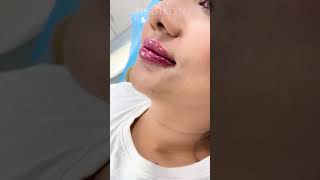 Lip Fillers Technique by Dr Muskan Tyagi  Dermalyn Aesthetics  APPOINTMENT CALL 9999189391 [upl. by Raamaj]