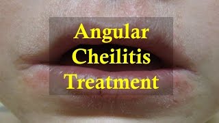 How to cure Angular Cheilitis Naturally [upl. by Evette855]