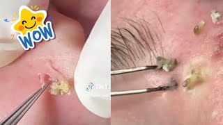 Ultimate Compilation of Most Satisfying Pimple Popping Blackhead Extractions amp Acne Treatment [upl. by Clovis]