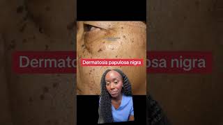 Why Do I Have These Dark Skin Spots Understanding Dermatosis Papulosa Nigra [upl. by Leggat300]