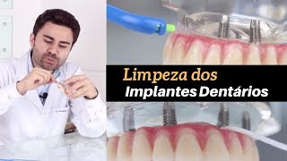 Limpeza de Implantes Dentários  3 Técnicas de Higienização [upl. by Henrie]