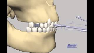 Head gear Orthodontic Head gear [upl. by Lehte762]