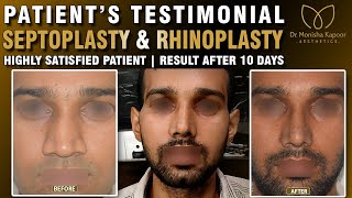 Correction Deviated Septum Septoplasty  Rhinoplasty Nose Before amp After Result  Happy Patient [upl. by Chelsae463]