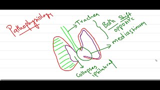 Tension Pneumothorax [upl. by Ainoek]