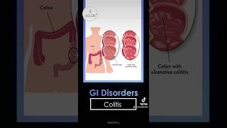 Gastrointestinal disorders  Infectious Ulcerative Crohns disease Ischemic Radiation colitis [upl. by Yattirb]