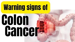 Colon cancer symptoms in Hindi  Colon cancer ke lakshan [upl. by Ennoval]