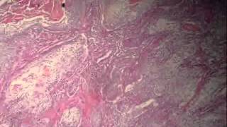 Bronchogenic carcinoma عملي عبد الرحمن خليفة [upl. by Lejna252]