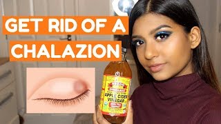 HOW TO GET RID OF A CHALAZION FAST AT HOME [upl. by Nojid217]