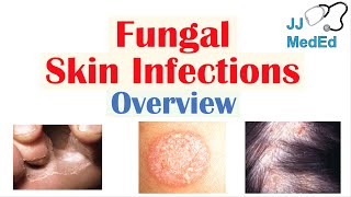 Overview of Fungal Skin Infections  Tinea Infections [upl. by Ymled]