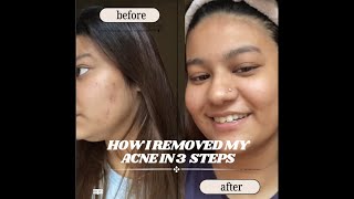 Remove your acne and acne spots in just 3 steps  Wellessia  Acneprone skincare routine [upl. by Aleacem]