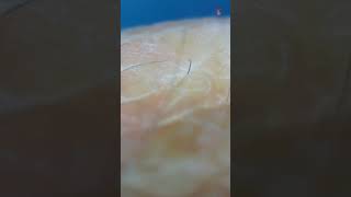 Exploring Hand eczema Under a Microscope HandEczema Eczema [upl. by Pet]