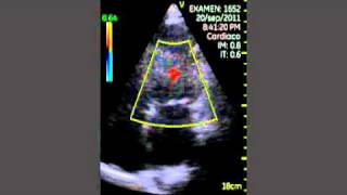 VSCAN Cardiac amyloidosis Pocket ultrasound [upl. by Relluf229]