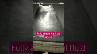 abdominal fluid ascites [upl. by Mou]