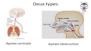 Faites Vous des Apnées de Sommeil [upl. by Longawa]