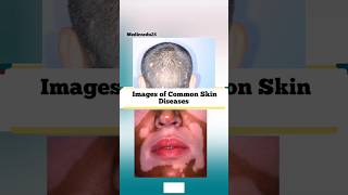 Skin Diseases Picture amp Names [upl. by Leber]