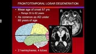 Overview of Frontotemporal Lobar Degeneration [upl. by Rengaw]