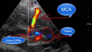 Pointofcare Transcranial Doppler [upl. by Noyk917]