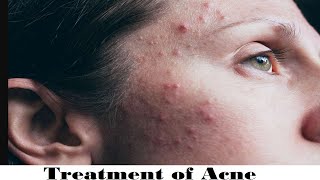 Treatment of Acne [upl. by Siuraj347]