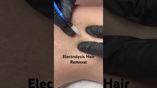 Electrolysis Hair Removal [upl. by Dielle]