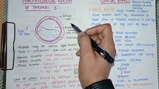 Thrombosis Part 2  Definition Causes Types Morphology amp Pathology [upl. by Viviyan277]