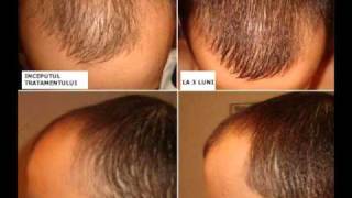 Tratament Păr  Scapă de chelie calviție alopecie Kirkland Minoxidil 5wmv [upl. by Gant601]