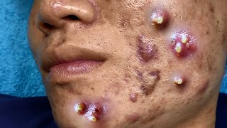 Big Cystic Acne Blackheads Extraction Blackheads amp Milia Whiteheads Removal Pimple Popping 095 [upl. by Earl]