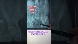 Urinary Bladder stone kidney kidneystone [upl. by Jerrie]