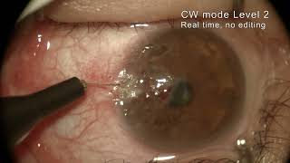 Corneal New Vessels treatment Realtime no editing [upl. by Mohsen]