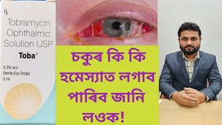 Toba Eye Drops Tobramycin Ophthalmic Solution USP [upl. by Rednas]