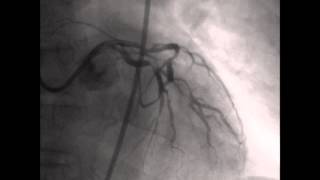 Coronary angiography CAG [upl. by Ailemrac]