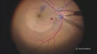 Macular hole Surgery [upl. by Terzas816]