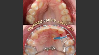 The art of impacted canine treatment  be aware￼ [upl. by Janicki]