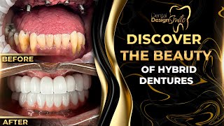 Discover the Beauty of Hybrid Dentures [upl. by Diver495]